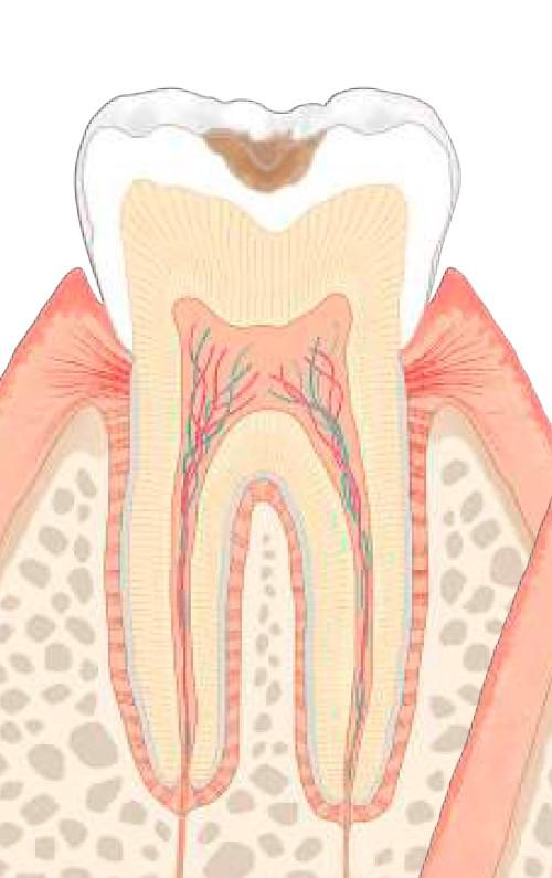 虫歯のレベル：C1