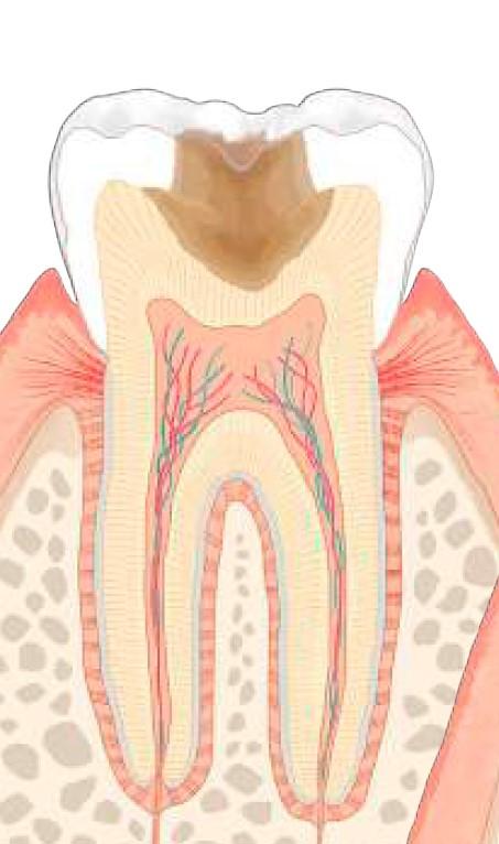 虫歯のレベル：C2