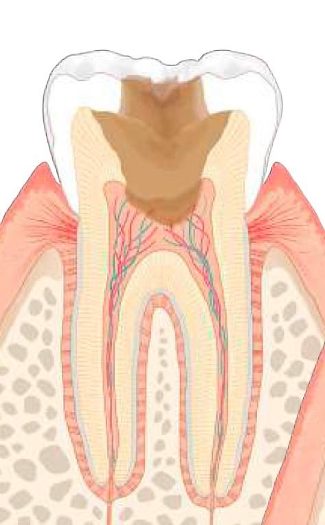 虫歯のレベル：C3