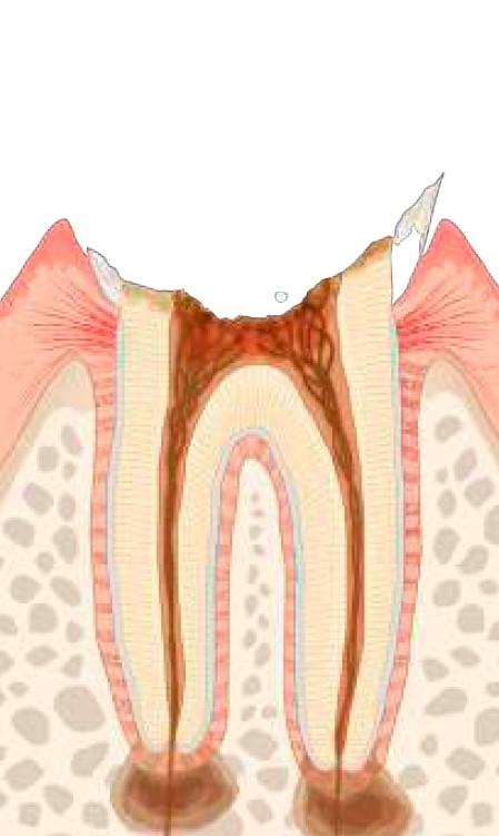 虫歯のレベル：C4